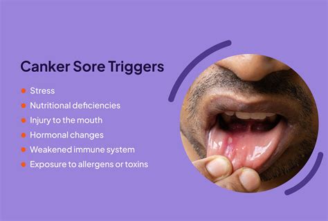 Canker Sore (Aphthous Ulcer): What It Is, Causes Treatment, 56% OFF