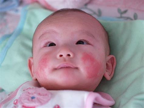 Baby Eczema Symptoms, Causes, Treatments and Triggers - Skin Disease Remedies