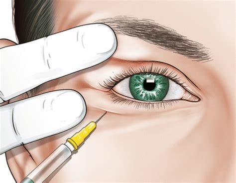 Anesthesia for the edge of the eyeball for optical iris removal surgery | Vinmec