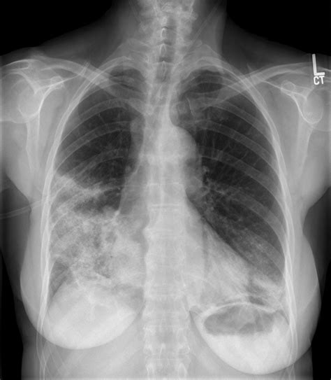 Bronchiolitis Obliterans Organizing Pneumonia/Cryptogenic Organizing Pneumonia - The Clinical ...