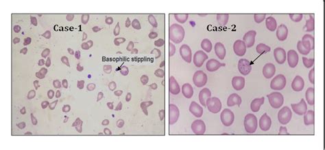 Figure 1 from Lead Poisoning Induced Severe Hemolytic Anemia, Basophilic Stippling,Mimicking ...