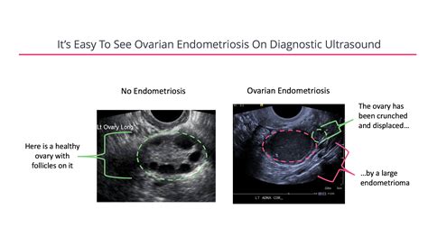 Diagnosing Endometriosis - FertilityIQ