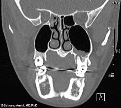 Roentgen Ray Reader: Periapical Cyst