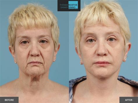 Facelift Before and After Photos Prove Just How Natural Today’s Results Look – TLKM Plastic Surgery