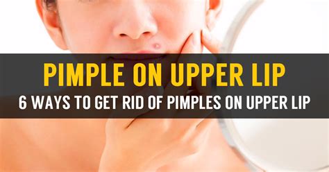 Learn How To Treat Pimple On Upper Lip & Causes