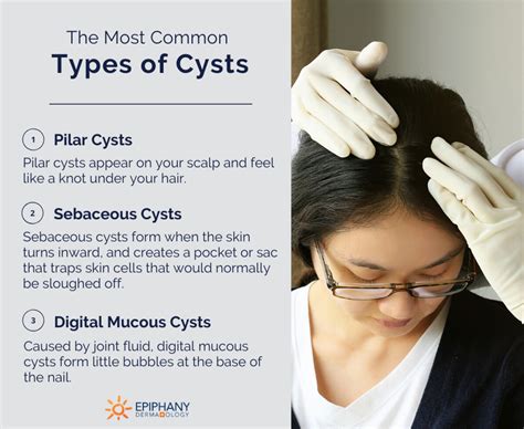 Sebaceous Cyst Epidermal Cyst Pictures Causes Treatment And Removal | Images and Photos finder