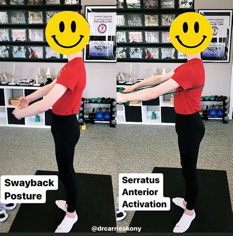 Swayback posture can also present in active postures (see previous post for explanation of ...