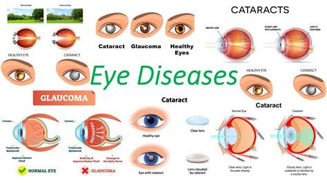 Eye Diseases - YouTube