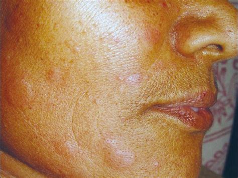 Hives on face: Treatments, symptoms, causes, and outlook