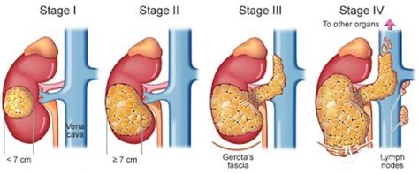 Wilms' Tumor Diagnosis and Staging