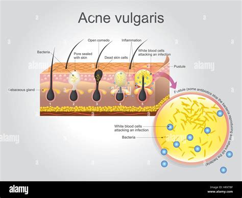 Acne vulgaris is a long-term skin disease that occurs when hair follicles become clogged with ...