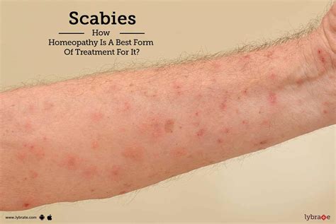 scabies treatment