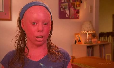 Harlequin Ichthyosis - Pictures, Survivor, Symptoms, Causes, Treatment