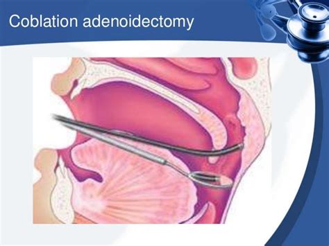 Adenoidectomy