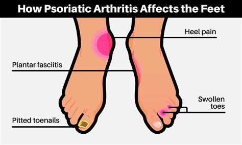 8 Ways To Manage Psoriatic Arthritis Foot Pain | MyPsoriasisTeam