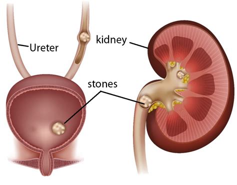 kidney stone: symptoms, risk factors, types, causes, - Health, Fitness ...