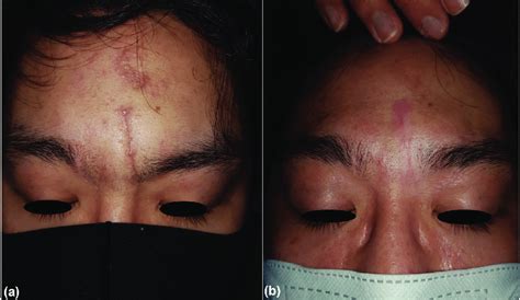 A 30-year-old male with a posttraumatic scar on the forehead by blunt... | Download Scientific ...