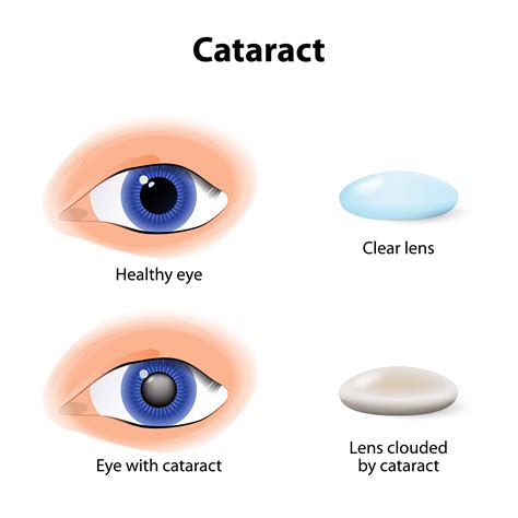 Cataract Center | Eye Associates of Lancaster Ltd