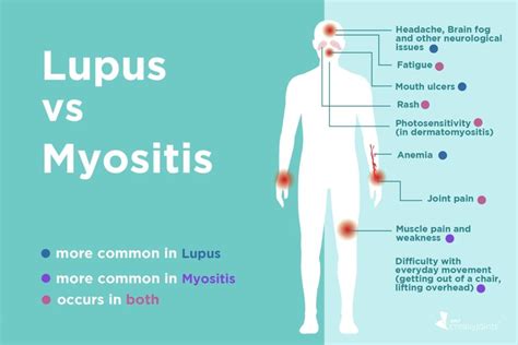 Lupus vs. Myositis: Differences in Symptoms and Treatments