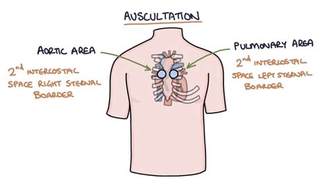 Heart Murmurs and Heart Sounds: Visual Explanation for Students - YouTube