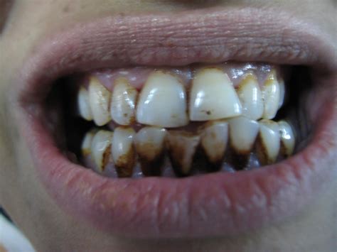 How To Remove Gutkha Stain From Teeth - TeethWalls