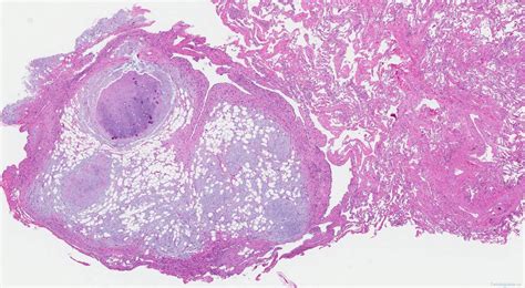 Hamartoma of the lung | Atlas of Pathology