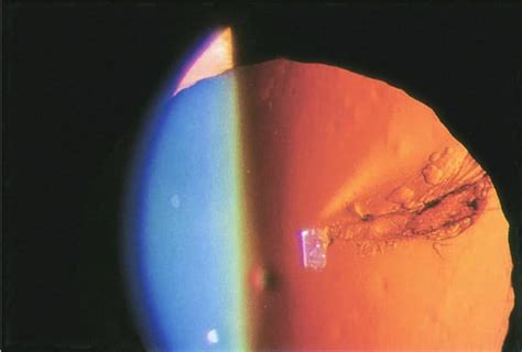 Types of cataracts - The Cataract Course