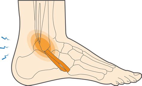 Peroneal Tendonitis Foot Hot Sale | cityofclovis.org