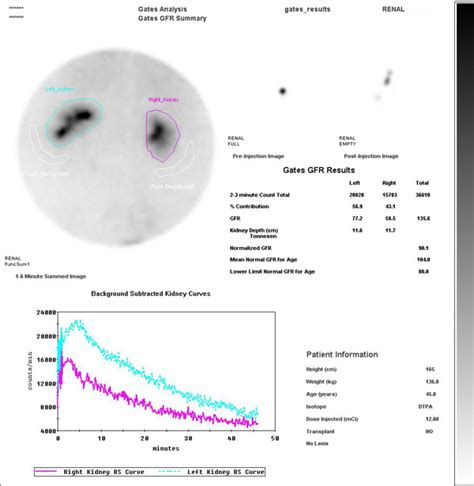 Renal Scan > For Doctors > Norfolk Nuclear Medicine Service