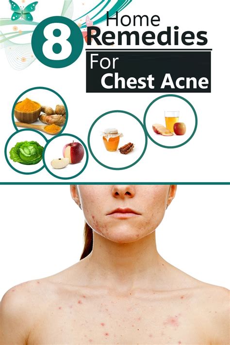 8 Effective Home Remedies For Chest Acne | Search Home Remedy