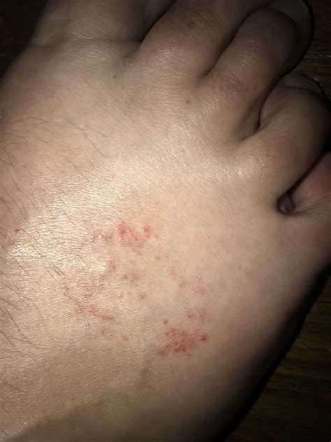 Rash on top of foot, raised small red bumps. Not itchy or painful. : r/Dermatology