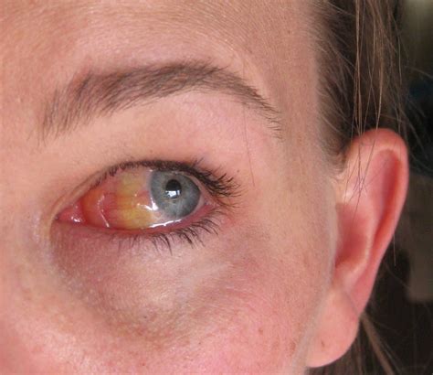 The Jonesy Files: Scleral Edema or Swollen Eyeball