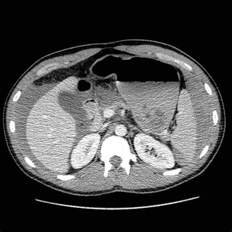 Hemoperitoneum - Gastrointestinal - Medbullets Step 2/3