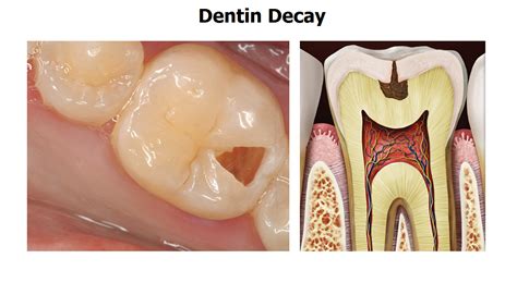 Difference Between Tooth Decay And Cavity at Wendell Thomas blog