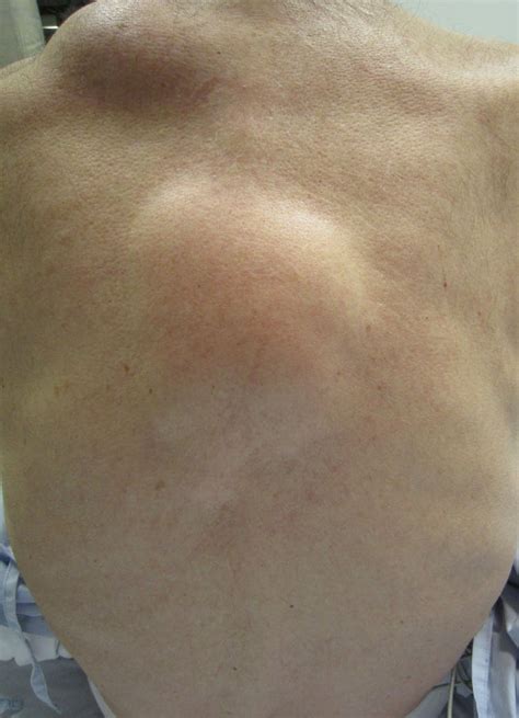 Common lumps and bumps on and under the skin: what are they?