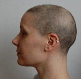 Hair Regrowth after Chemo – Pictures of Post Chemotherapy Growing Hair