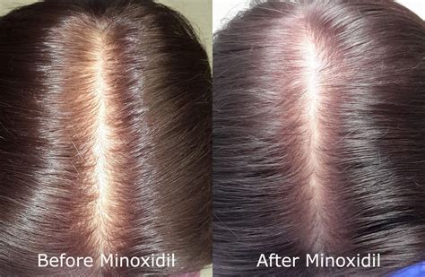 Can Rogaine (Minoxidil) Make Hair Loss Worse? | Limmer HTC