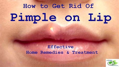 How to Get Rid of a Pimple on Lip?: Best 9 Remedies and Treatments