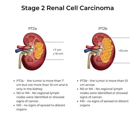 Kidney Cancer Stages | KCCure | kidney cancer | diagnosis | stages