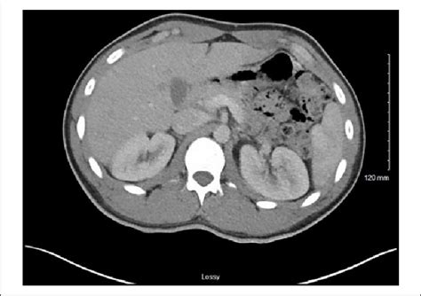 Normalized renal perfusion on follow-up imaging. | Download Scientific ...