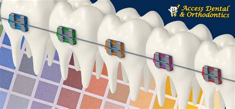 Braces Colors: How to Choose the Best Color for Your Smile - Access Dental Clinics