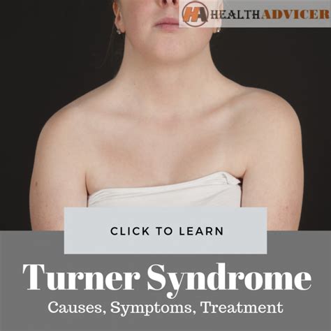 Turner Syndrome: Causes, Picture, Symptoms and Treatment