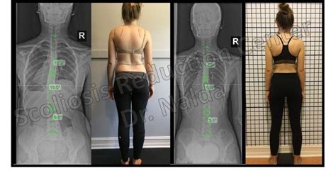 Scoliosis Treatment Results - See Before and After Pictures