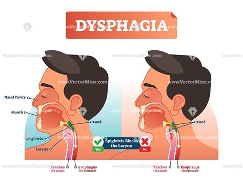 Dysphagia anatomical cross section diagram, vector illustration | Dysphagia, Nasal cavity, Trachea