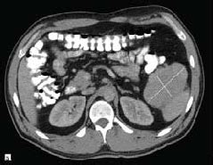 a: Axial CT images of accessory spleen (lines). | Download Scientific Diagram