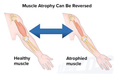 How to Fight Muscle Atrophy After Injury: A Personal Trainer’s Guide