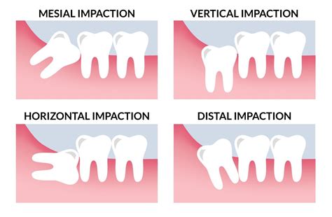 Wisdom Teeth Removal Mesa AZ | Eastport Dental AZ