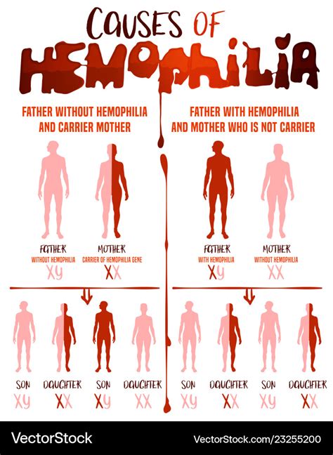 Hemophilia causes poster Royalty Free Vector Image