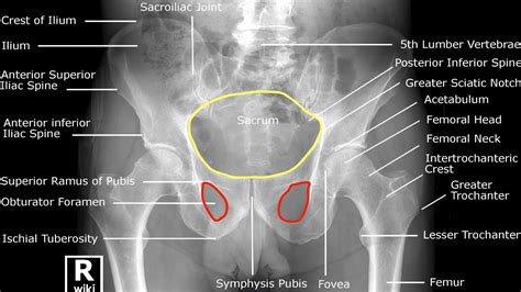 Hip X-ray Interpretation - OSCE Guide | Geeky Medics