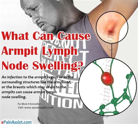 Armpit Lymph Node Swelling